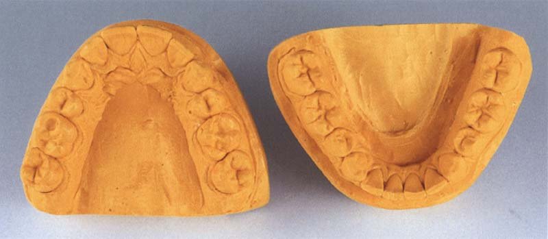 Dental World Cast Pedo Upper