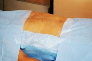 Ortholink Incise Drape Special- Size 90x25 cm, adhesive60x25 cm